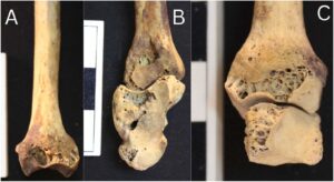 الكشف عن اقدم حالة التهاب المفاصل الروماتويدي في مصر القديمة حتى الآن