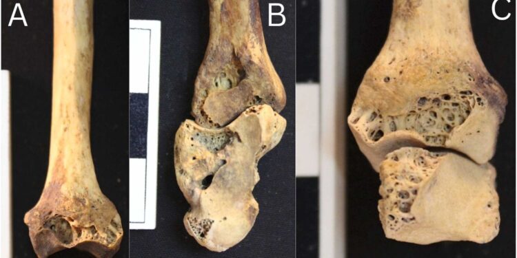 الكشف عن اقدم حالة التهاب المفاصل الروماتويدي في مصر القديمة حتى الآن